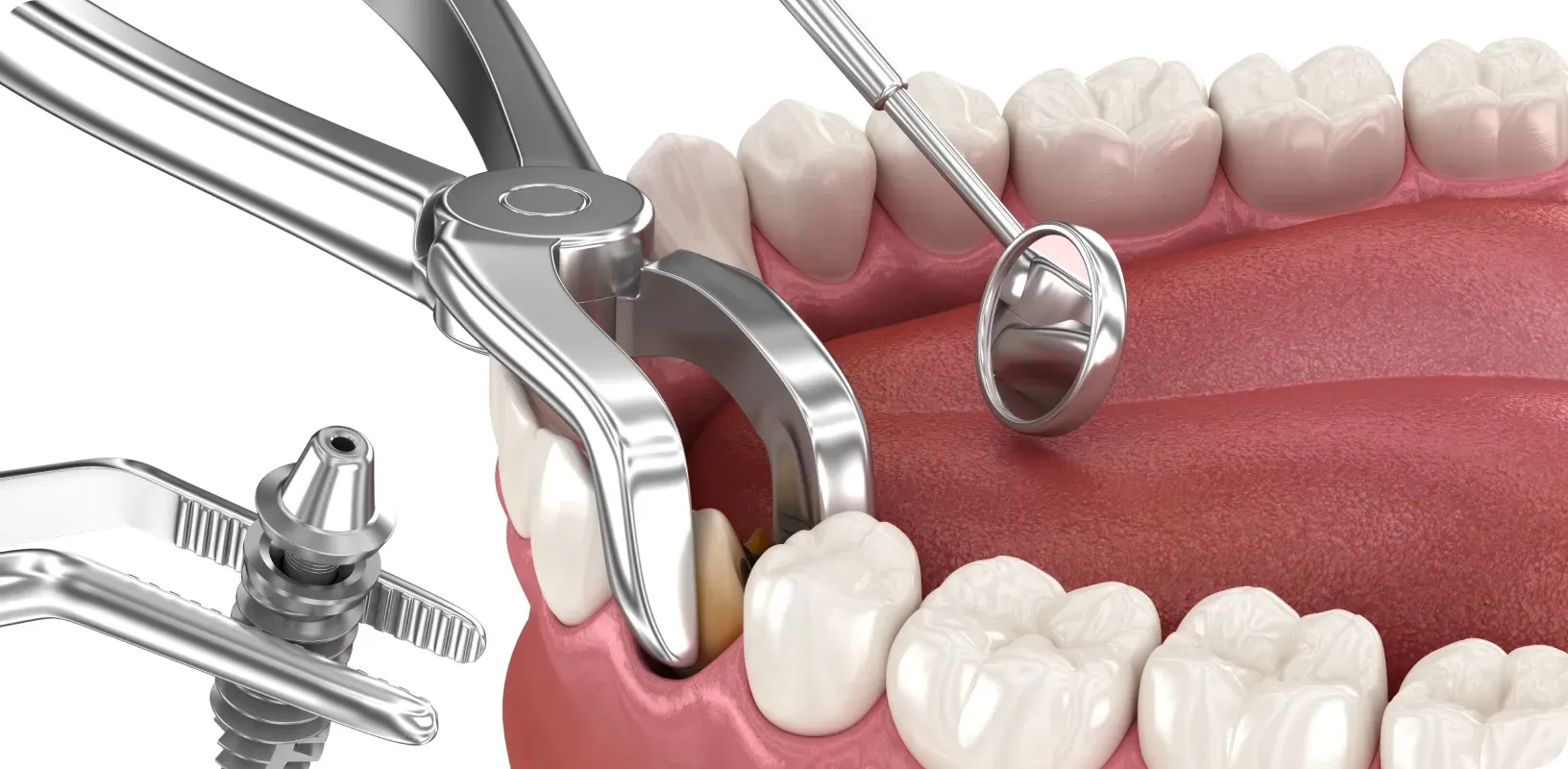 Extraction implantation immédiate au cabinet dentaire des Drs Kaabar & Deschatres à Antony